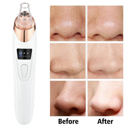 5 in 1 Electric Blackhead Remover Beauty Device